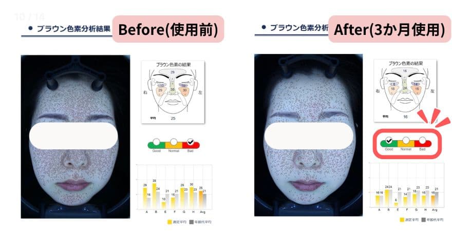 VISIA肌診断機「色素沈着」の項目のビフォーアフター