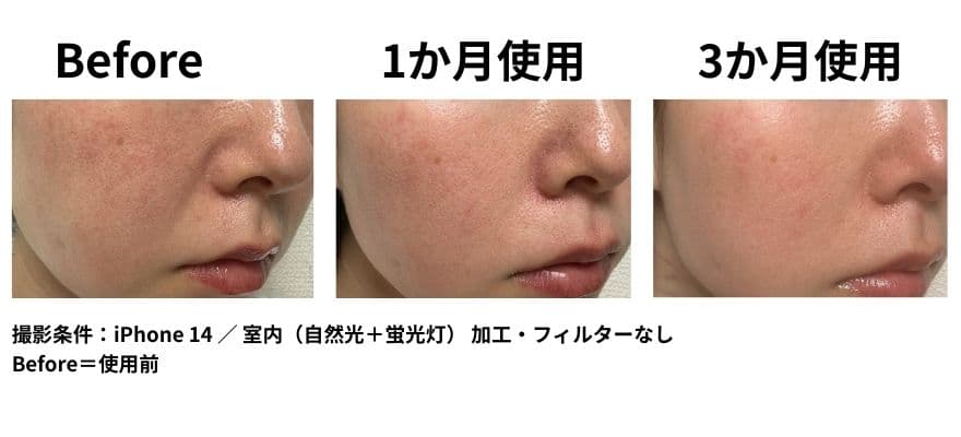 写真で比較│カレントボディLEDマスクを1か月・3か月使用したほうれい線への効果