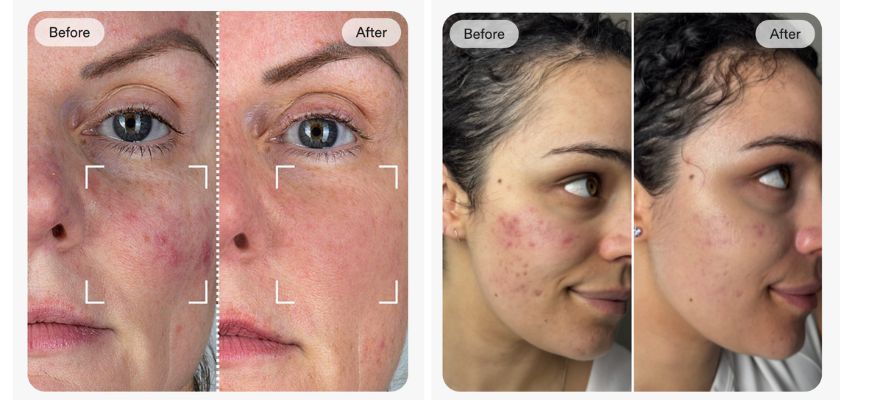 カレントボディ公式サイトのLEDマスクの効果 ビフォーアフター