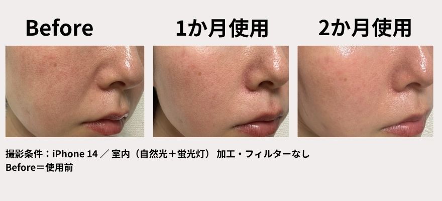 カレントボディLEDマスクシリーズ2を使用して2か月の変化