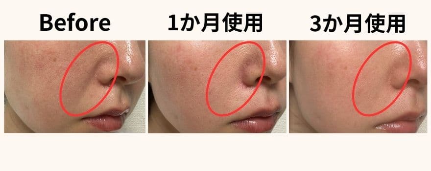 カレントボディLEDマスクシリーズ2を使用して3か月の変化