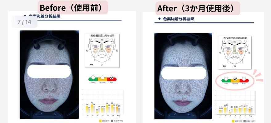 VISIA肌診断機「色素沈着」の項目のビフォーアフター
