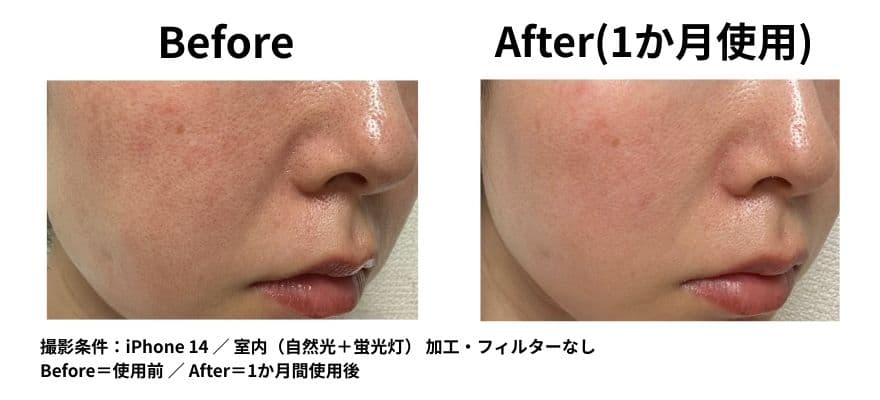 カレントボディ LEDマスクシリーズ2を使用して1ヶ月のビフォーアフター ほうれい線の変化