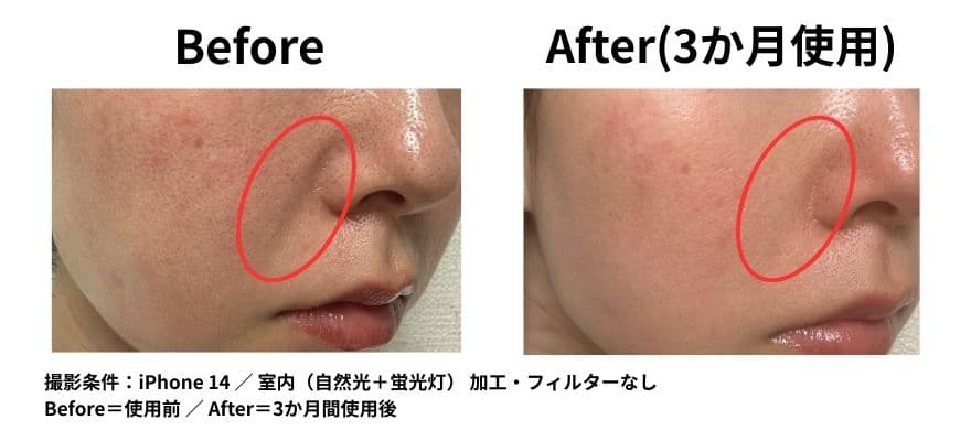 カレントボディ LEDマスクシリーズ2を使用して3ヶ月のビフォーアフター