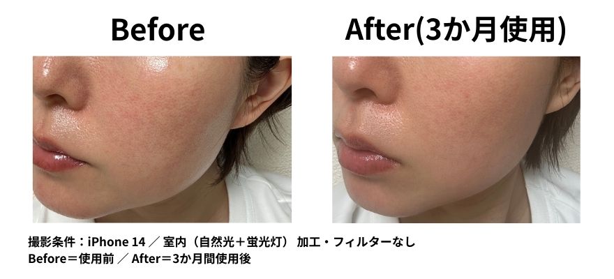 カレントボディ LEDマスクシリーズ2を使用して3ヶ月のビフォーアフター ハリの変化