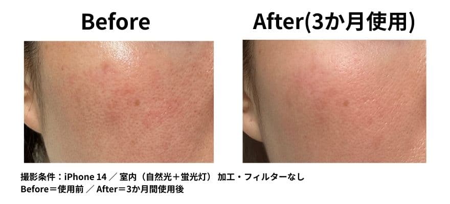 カレントボディ LEDマスクシリーズ2を使用して3ヶ月のビフォーアフター くすみの変化