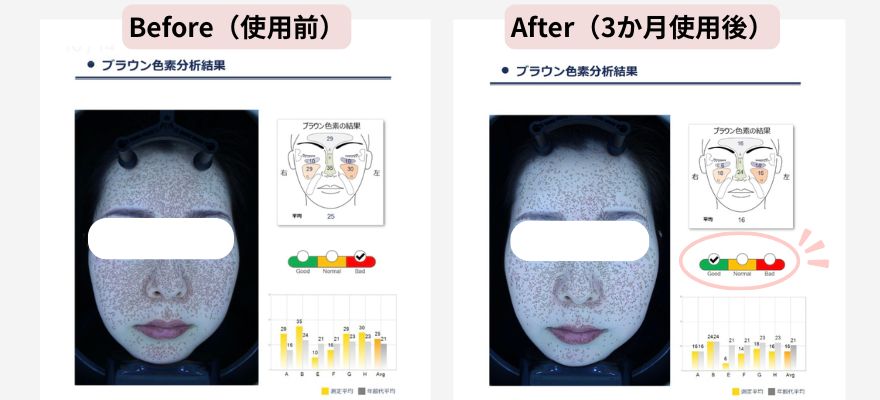VISIA肌診断機「ブラウン色素」の項目のビフォーアフター