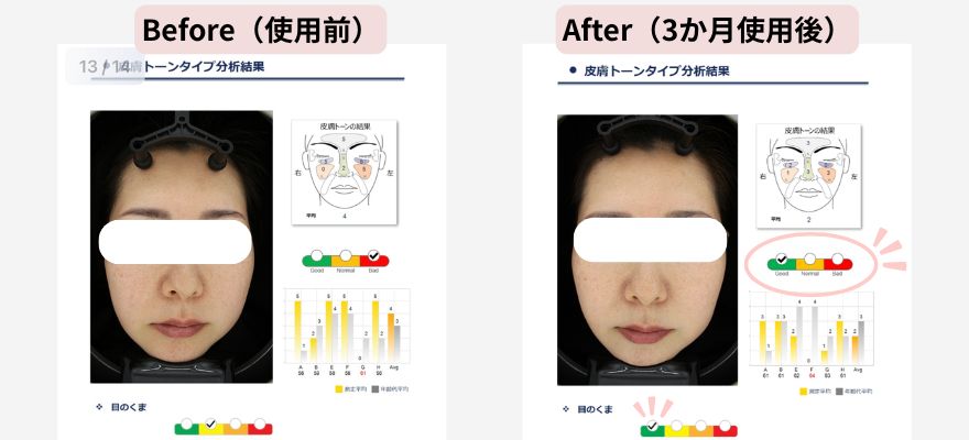 VISIA肌診断機「皮膚トーンタイプ」の項目のビフォーアフター