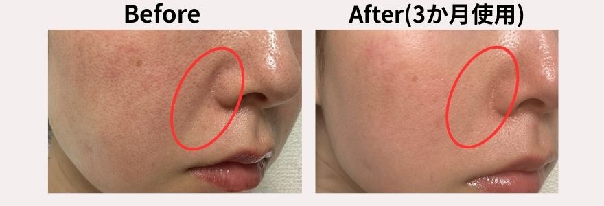 カレントボディLEDマスクの使用前と使用3か月後のほうれい線の変化