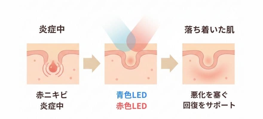 カレントボディLEDマスクは赤く腫れたニキビに効果的