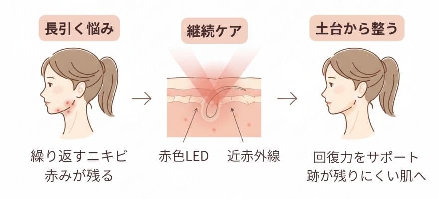 カレントボディLEDマスクは繰り返すニキビ・跡に効果体