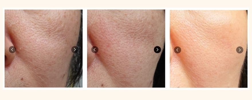 トリアレーザー美顔器を9か月使用した50代前半女性の1か月半使用のビフォーアフター