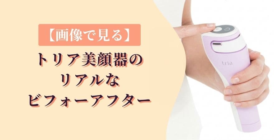 【画像で見る】トリアレーザー美顔器のリアルなビフォーアフター