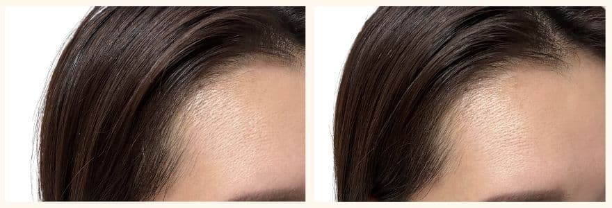 カレントボディ頭皮・頭髪ケアデバイスをの使用前と使用して1か月