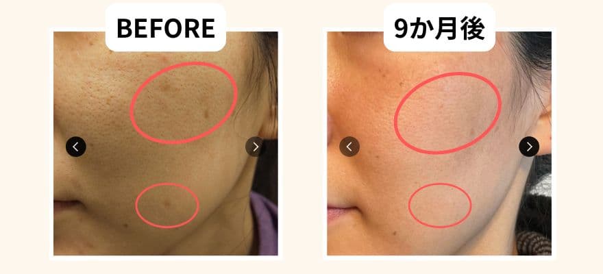 ※実際に9か月使用した方のリアルな肌変化です