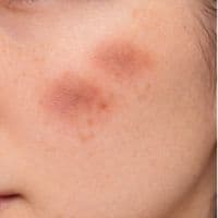 炎症後色素沈着