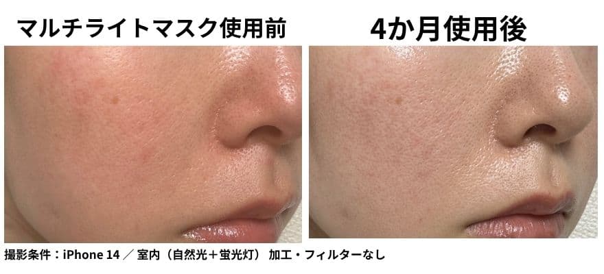 カレントボディLEDマルチライトマスクを4か月使用した頬の比較｜肌トーンと色ムラ