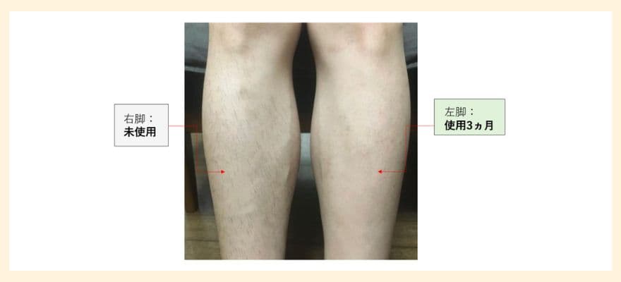 トリア4Xを3か月使用した男性のすね毛のビフォーアフター