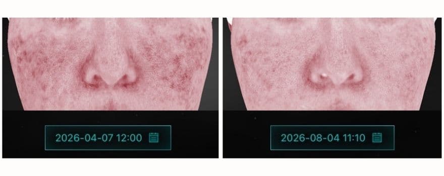 2026年4月と8月に、同じ美容皮膚科・同じ肌診断機で撮影した画像