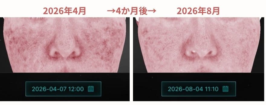2026年4月と8月に、同じ美容皮膚科・同じ肌診断機で撮影した画像