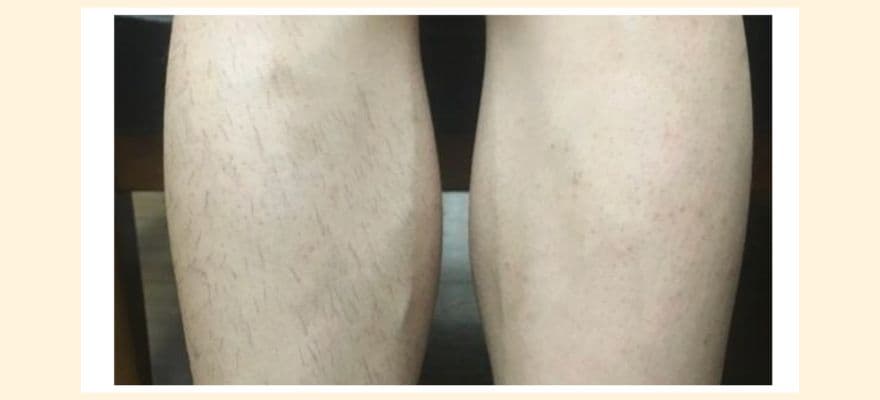 トリアから提供いただいた男性のトリア4Xの使用例